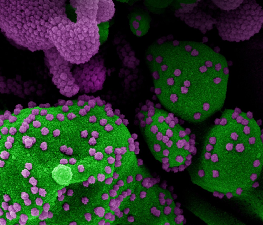 É o primeiro caso do mundo de reinfecção com a mutação. Imagem - NIAID Integrated Research Facility (IRF) 