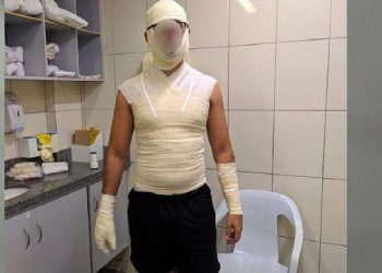 Homem sofre queimaduras de segundo grau após coxinha explodir: ‘Voou igual foguete’