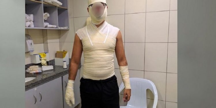 Homem sofre queimaduras de segundo grau após coxinha explodir: ‘Voou igual foguete’