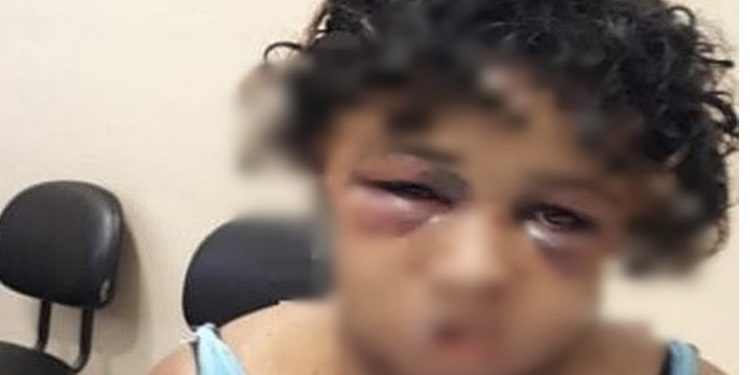 Homem espanca esposa por quatro horas e queima rosto da vítima com maçarico em Salvador