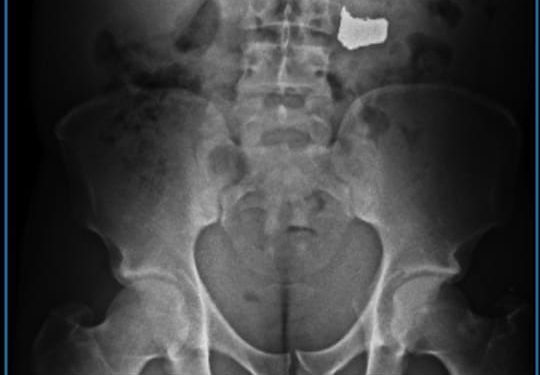 Bandido rouba corrente e engole para não ser preso em Salvador