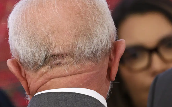 Após cirurgia no crânio, presidente Lula ‘encontra-se bem’, diz boletim médico