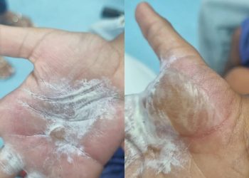 USOU COLHER QUENTE: mãe é acusada de queimar as mãos dos filhos em São Francisco do Conde