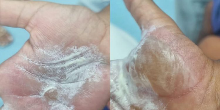 USOU COLHER QUENTE: mãe é acusada de queimar as mãos dos filhos em São Francisco do Conde