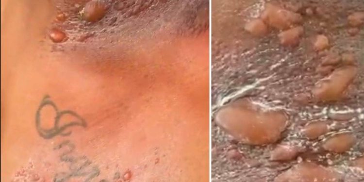 Soldado da PM sofre queimaduras graves durante treinamento na Bahia