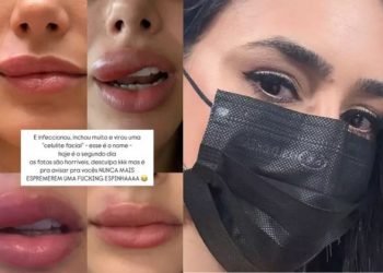 Bruna Biancardi é diagnosticada com infecção grave no rosto