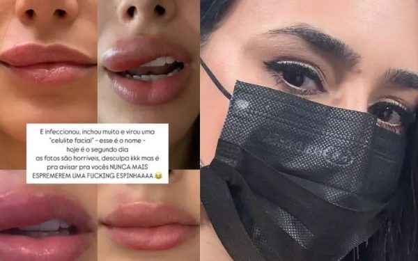 Bruna Biancardi é diagnosticada com infecção grave no rosto